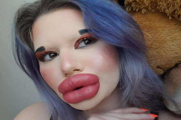 Sudah Terbesar di Dunia, Wanita Ini Akan Suntik Bibir ke-27 Kalinya