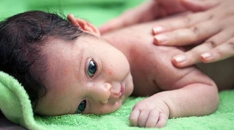 5 Cara Alami Atasi Biang Keringat pada Bayi, Bunda Wajib Coba!