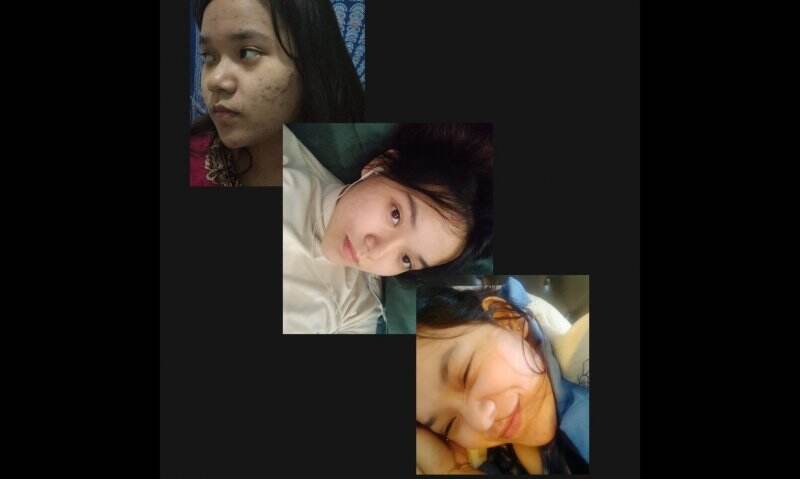 MY ACNE`s JOURNEY