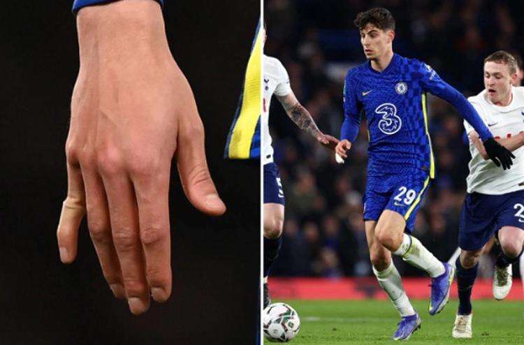 Mengerikan! Jari Tangan Kai Havertz Patah usai Robek Gawang Tottenham
