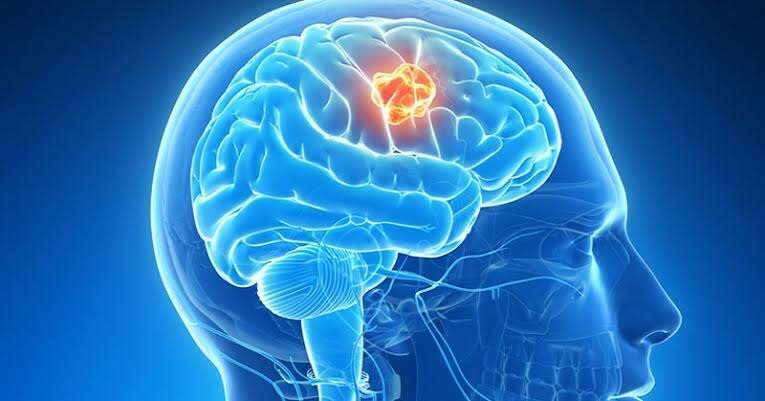 Calon Suami Melanie Putria Kena Tumor Otak, Yuk Kenali 14 Tanda-tandanya